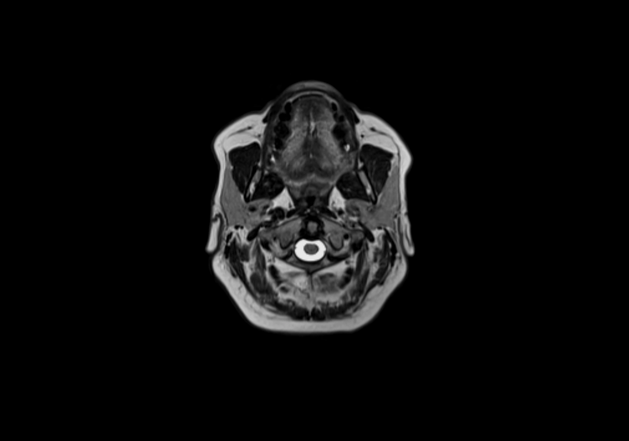 Neck axial  lymph node cross sectional MRI anatomy 3T MRI  image-img-00001-00032.webp